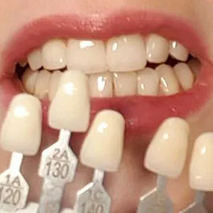 Zahnersatz & Implantate – Wir ersetzen fehlende oder stark geschädigte Zähne mit Kronen, Brücken, Implantaten oder hochwertigen Prothesen – ästhetisch, funktional und individuell auf Ihre persönlichen Bedürfnisse abgestimmt. Zahnarztpraxis in Iserlohn-Letmathe, Dr. med. dent. Melanie Sellhorst